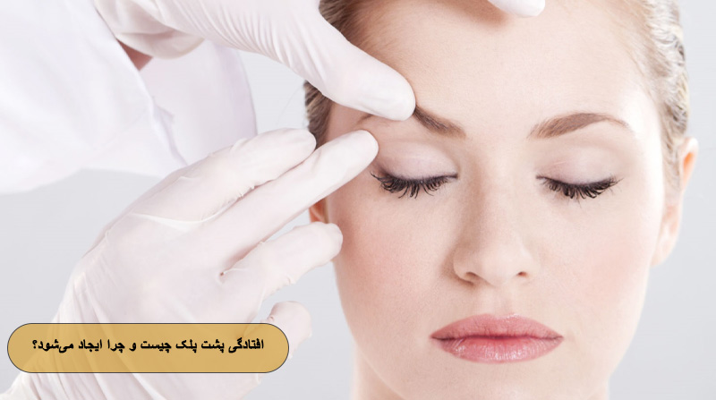 افتادگی پشت پلک چیست