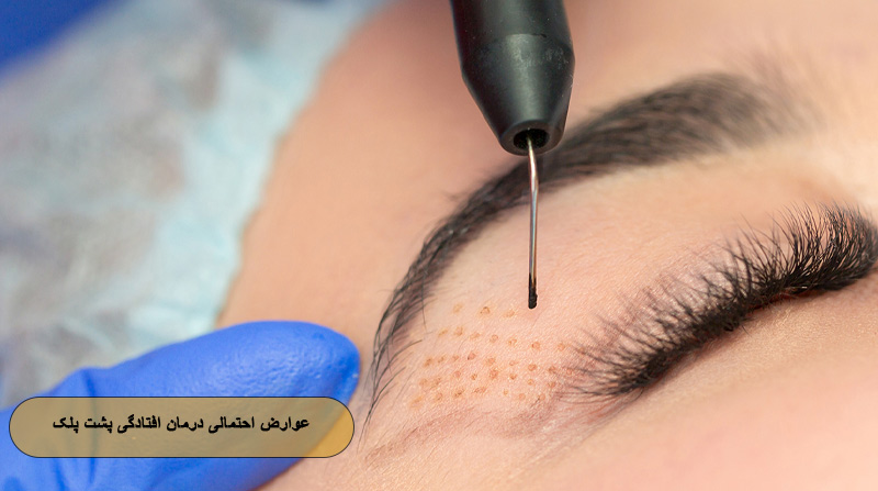 عوارض احتمالی درمان افتادگی پشت پلک