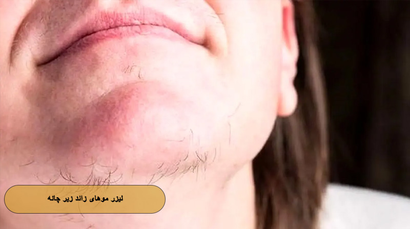 لیزر زیر چانه