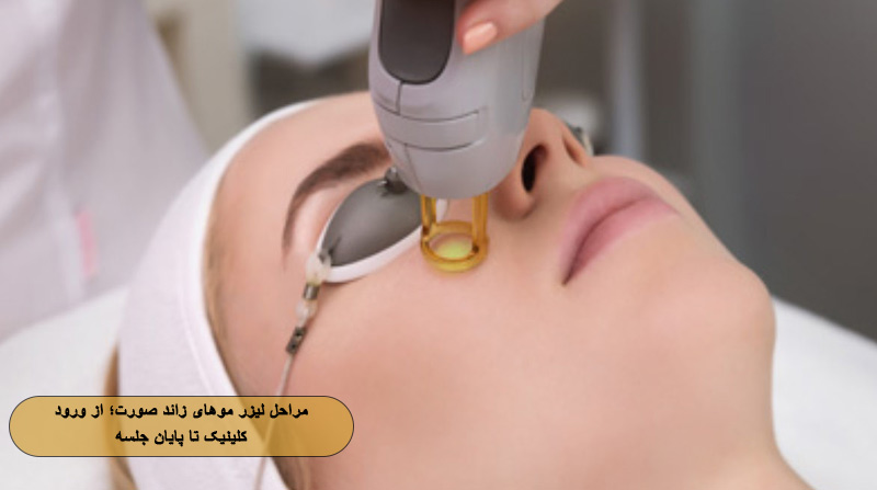 مراحل لیزر موهای زائد صورت