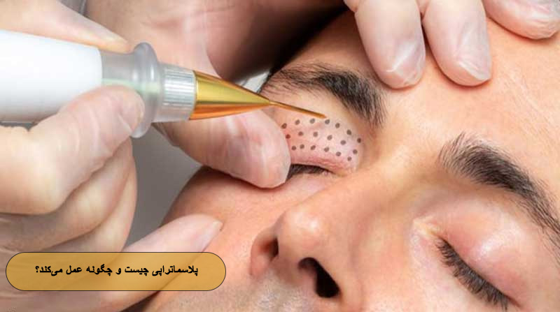 پلاسماتراپی چیست و چگونه عمل می‌کند؟